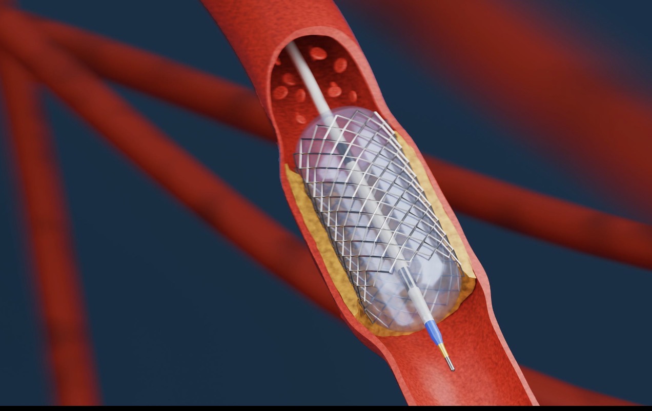 Coronary Angioplasty & Stenting