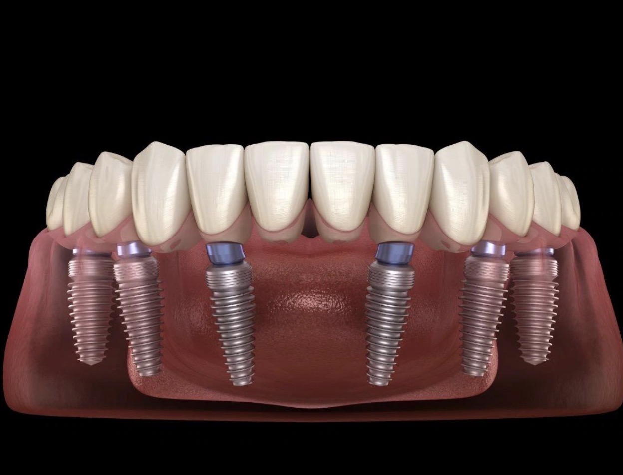 Dental implants (All-on-6)