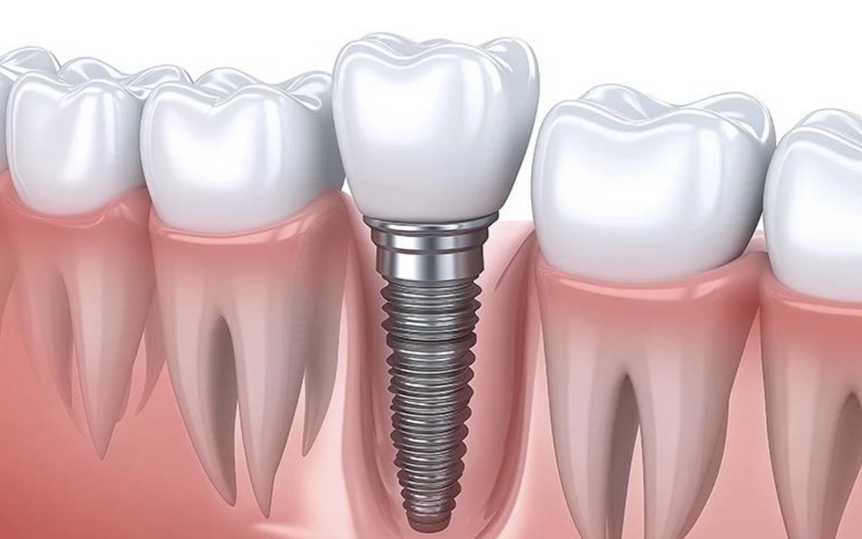 Single tooth replacement