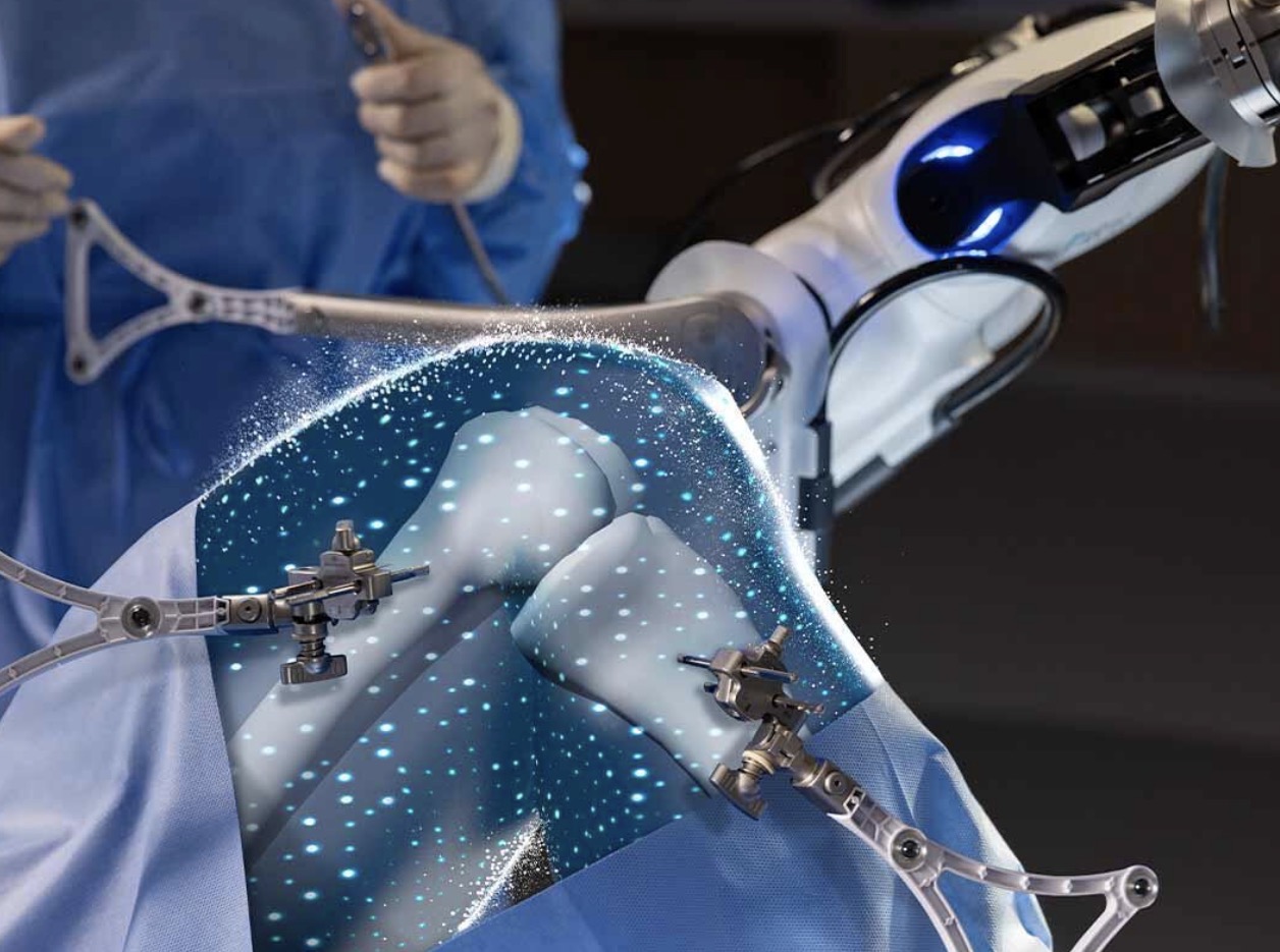 Robotic Knee Replacement Surgery