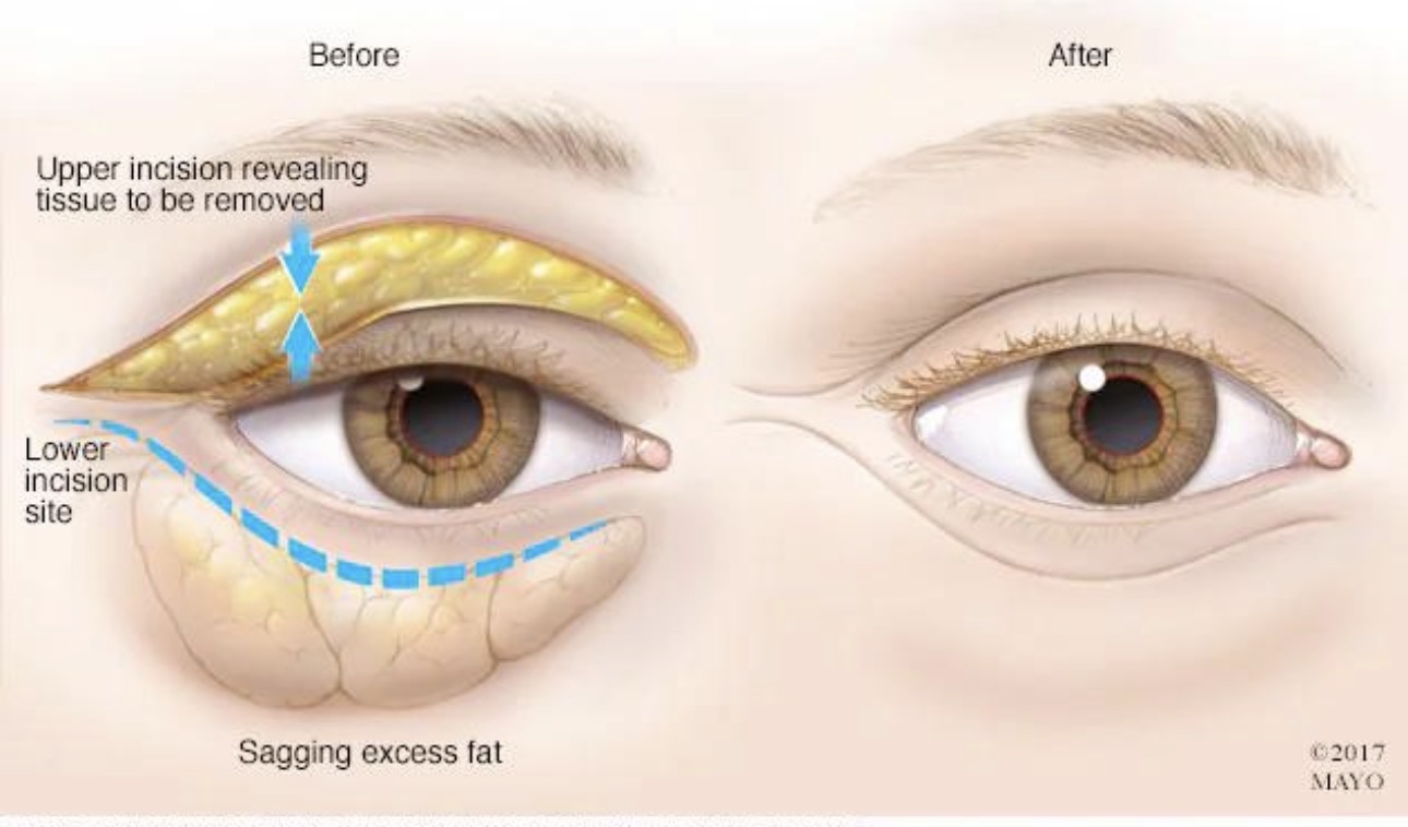 Blepharoplasty
