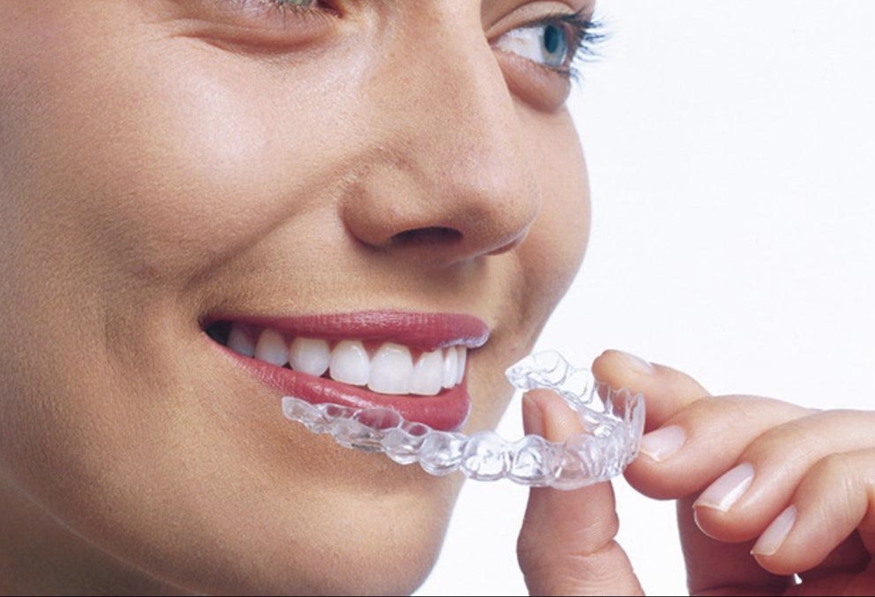 Braces (Clear Aligners)