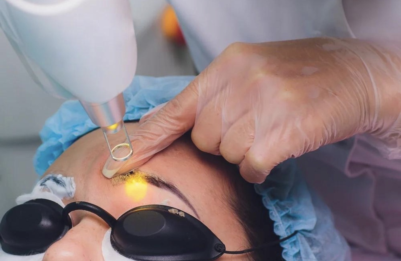 Laser Based Procedures