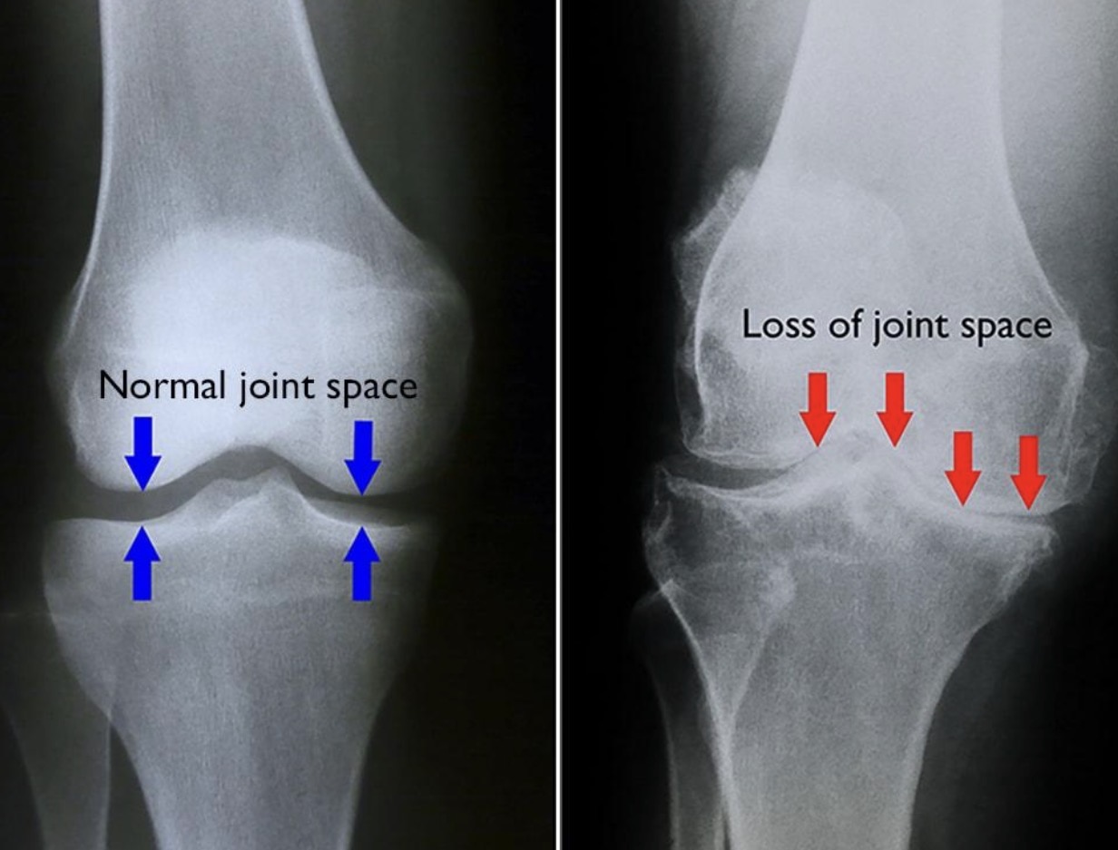 Bone & Joint Disorders