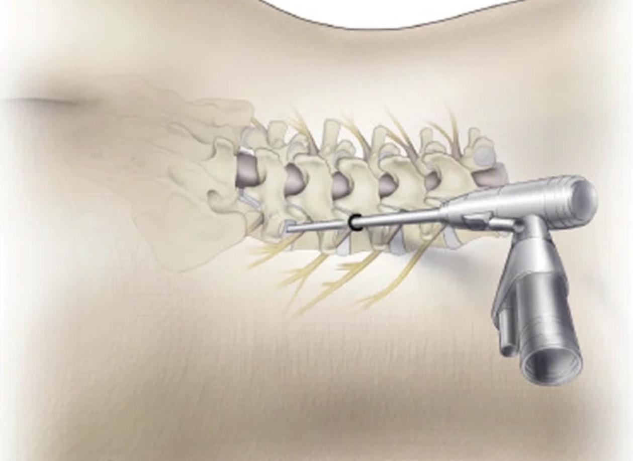 Spine (Back & Neck) Surgeries