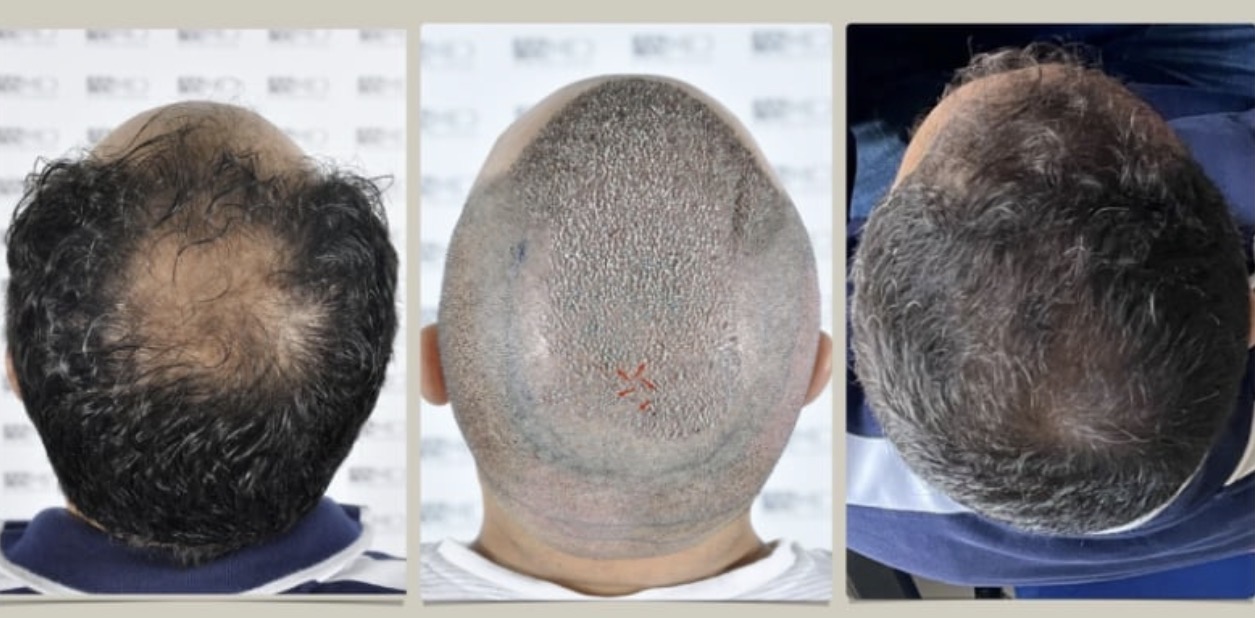 Hair transplant