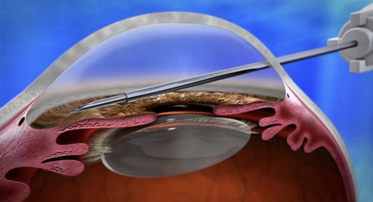 Glaucoma Treatment
